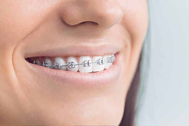 Best Traditional Braces  in Ossian, IN